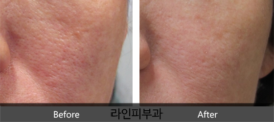 모공