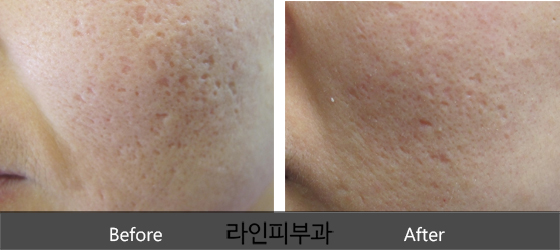 여드름흉터 치료